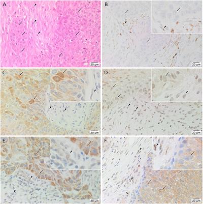 Cancer Stem Cell Subpopulations Are Present Within Metastatic Head and Neck Cutaneous Squamous Cell Carcinoma